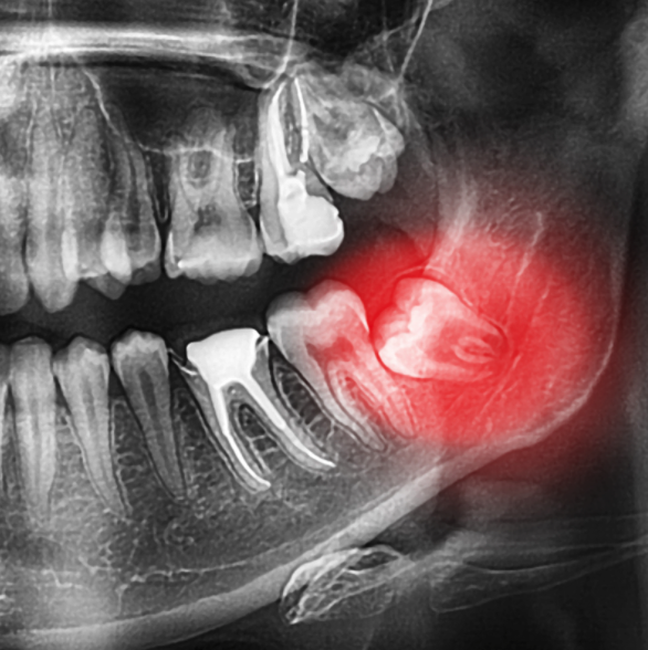 Wisdom Tooth Highlighted In Red On X-Ray Of Mouth 
